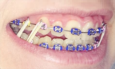 ligas metalicas brackets|gomitas para brackets.